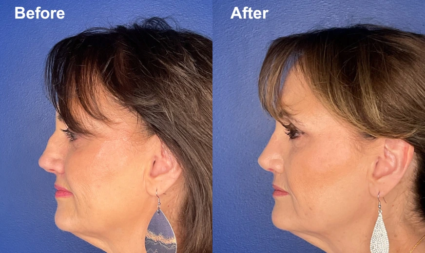 Woman's profile before and after facial plastic surgery showing enhanced facial balance
