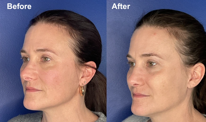 Before and after profile photos showing improved jawline and chin projection