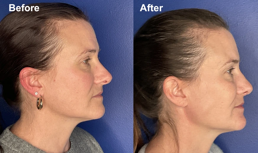 Before and after profile photos showing improved cheek and chin definition