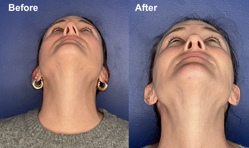 Before and after upward-angled neck photos showing improved chin and jawline definition