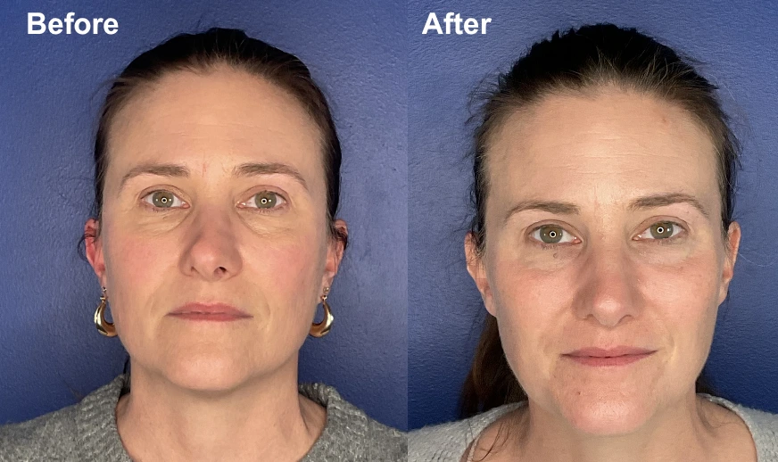 Before and after front-facing facial photos showing improved skin texture and facial contours