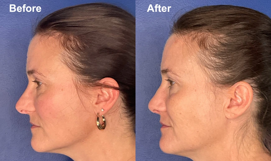 Before and after profile views showing facial rejuvenation results
