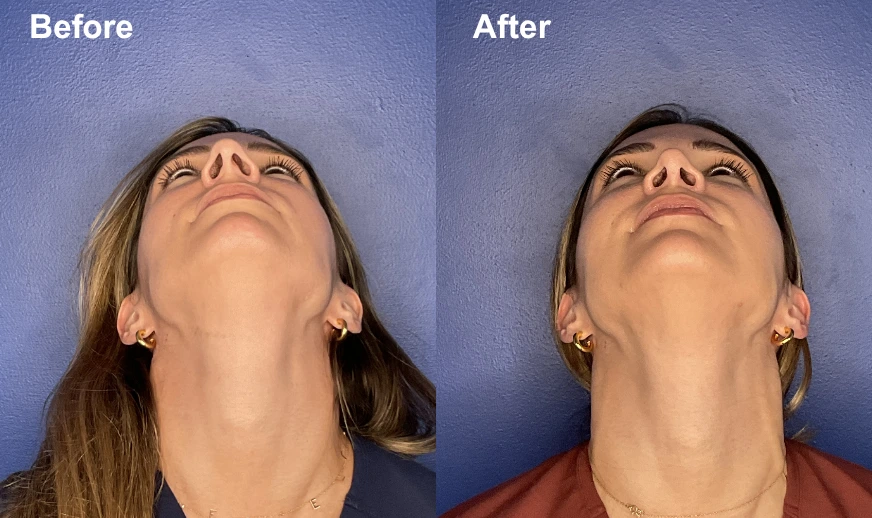 Before and after upward-facing view showing refined chin and neck definition