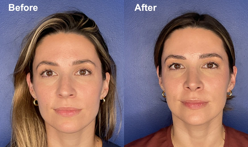 Before and after facial photos showing front-facing view of patient with improved facial definition and skin texture