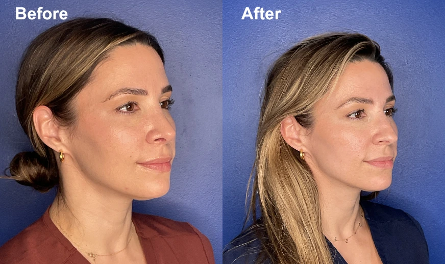 Before and after side profile comparison showing improved facial contours and definition