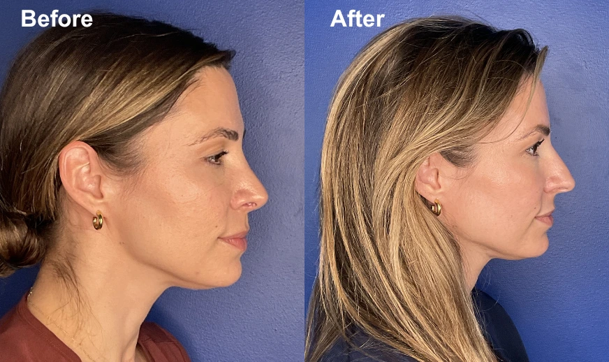Before and after side profile comparison showing enhanced chin projection and jawline