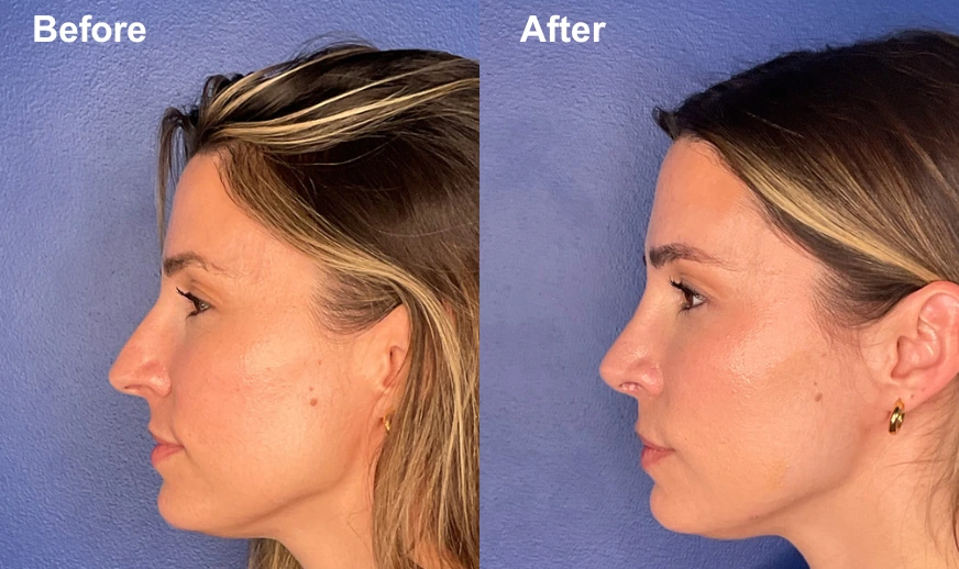Before and after profile views showing refined facial contours