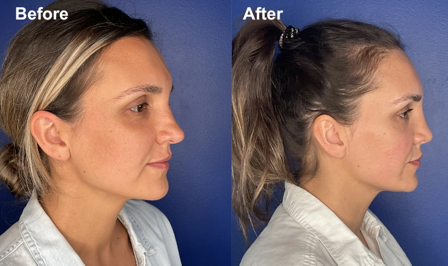 Before and after side profile comparison showing enhanced jawline contour