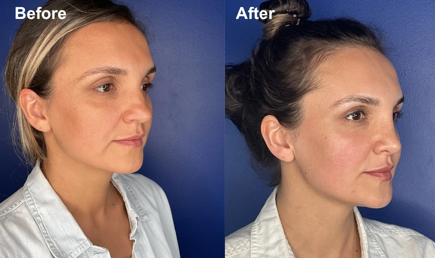 Before and after side profile comparison showing refined chin and jawline projection