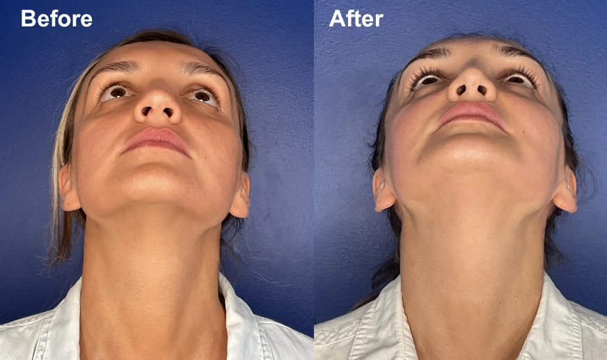 Before and after upward-facing view showing nose and chin refinement with improved facial proportions