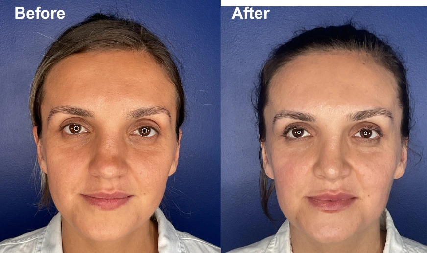 Before and after frontal facial comparison showing reduced puffiness and improved definition