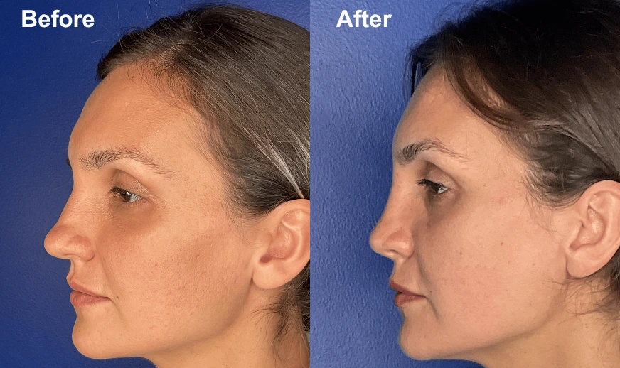 Before and after profile views showing improved facial definition