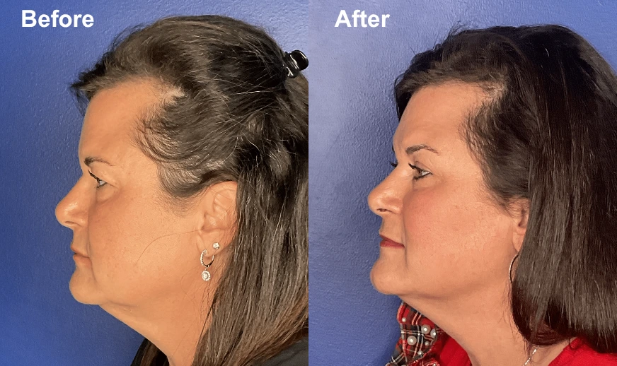 Before and after profile views showing rhinoplasty results