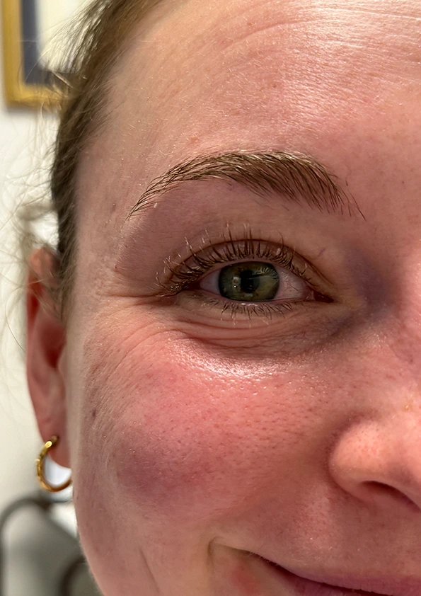 Close-up of patient's eye showing full lash extensions with enhanced volume and length