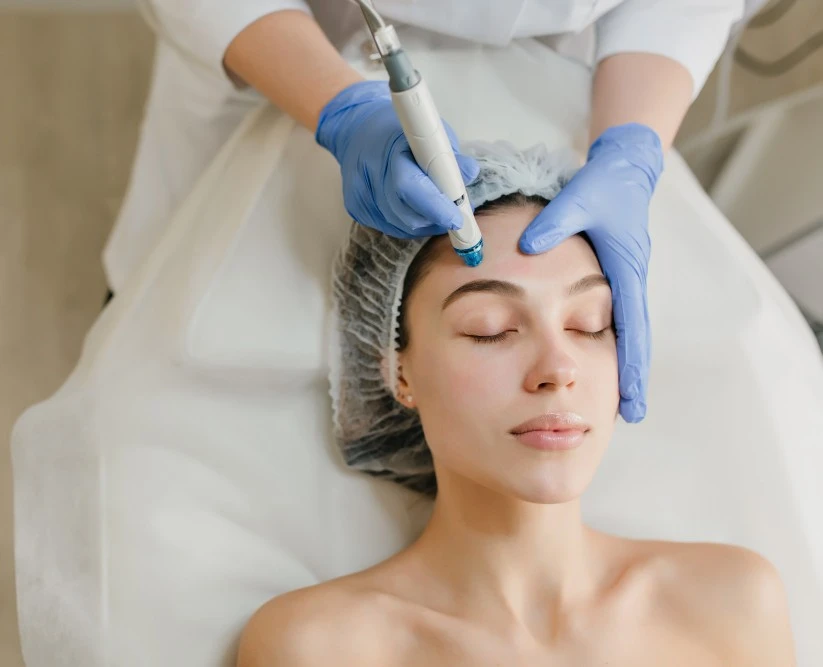 Aesthetician using microneedling device on patient's forehead during facial treatment