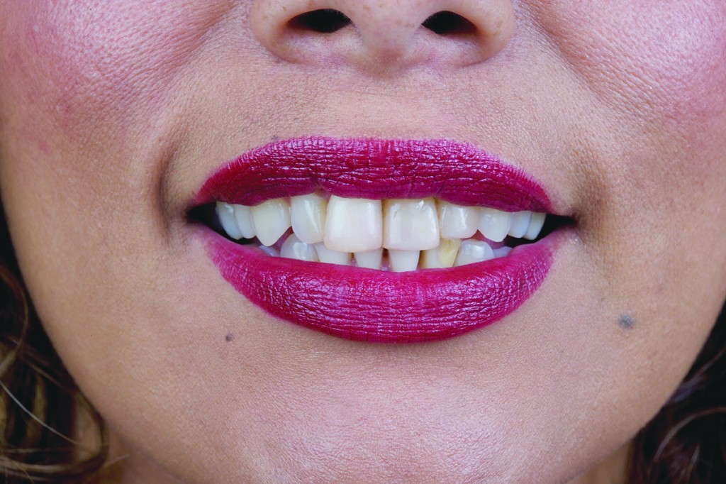 veneers before | Advanced Dentistry of Collegeville