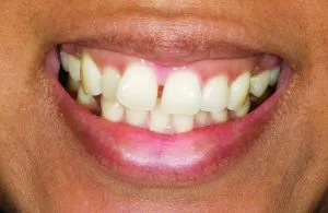 Before smile photo showing discolored and misaligned teeth with visible gaps