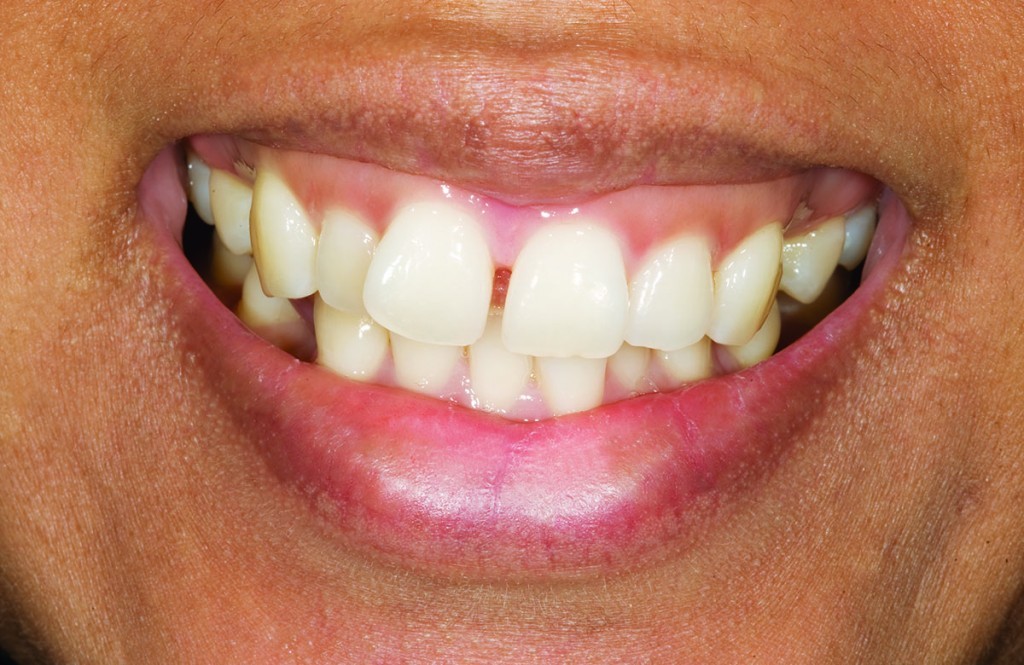 venners before | Advanced Dentistry of Collegeville