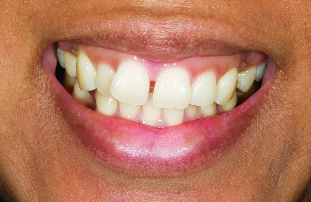 Before smile photo showing discolored and misaligned teeth with visible gaps