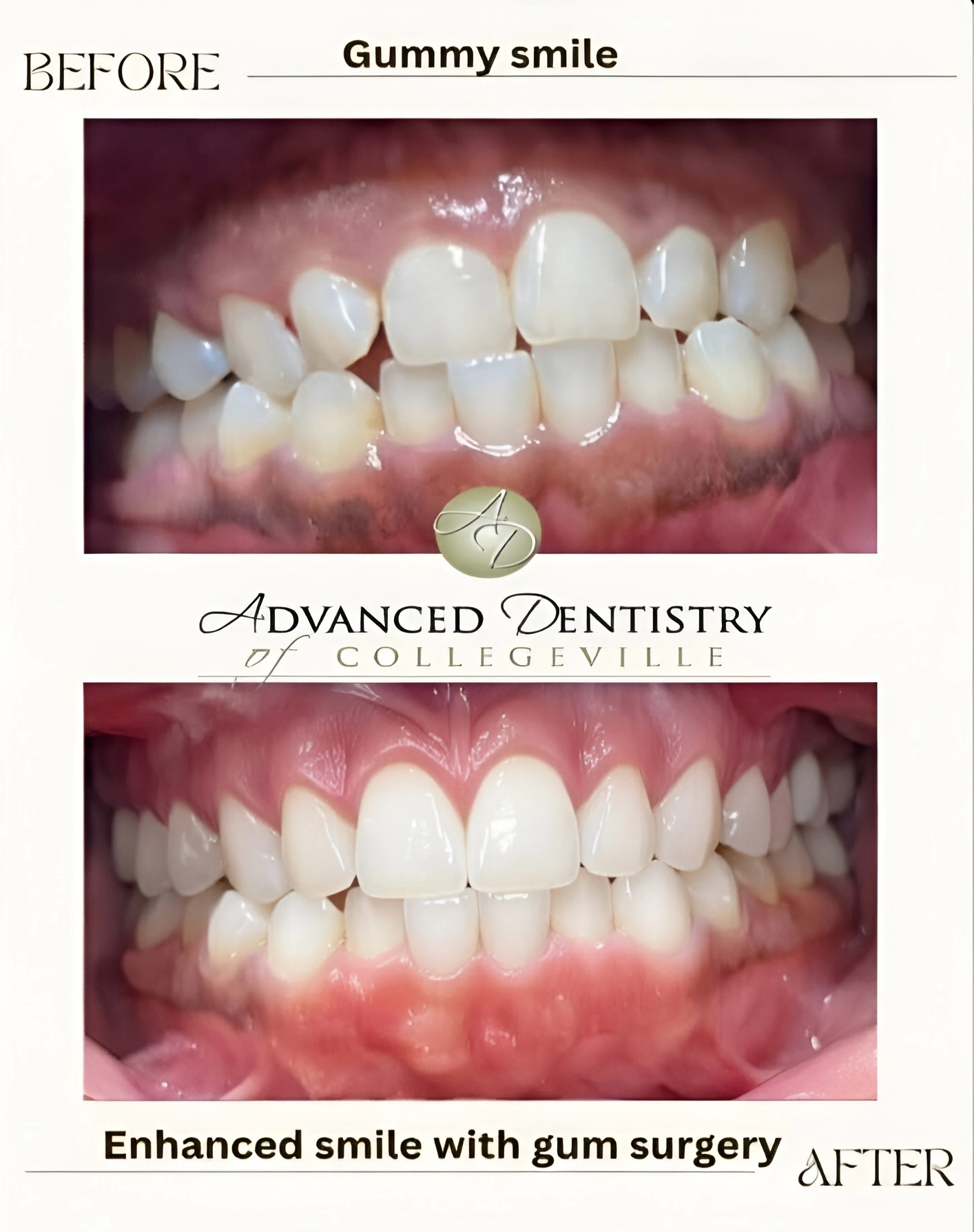 Before and after of a gummy smile corrected with gum surgery, showing longer, even front teeth