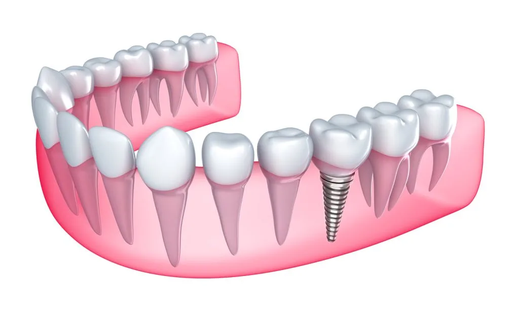 3D illustration of dental implant with screw anchor in jawbone surrounded by natural teeth