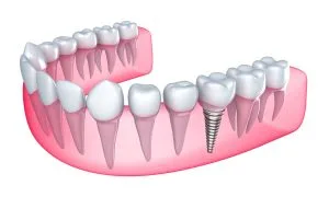 3D illustration of dental implant with screw anchor in jawbone surrounded by natural teeth