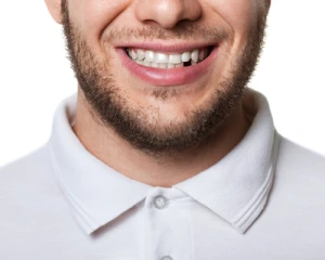 Missing teeth | collegeville advanced dentistry