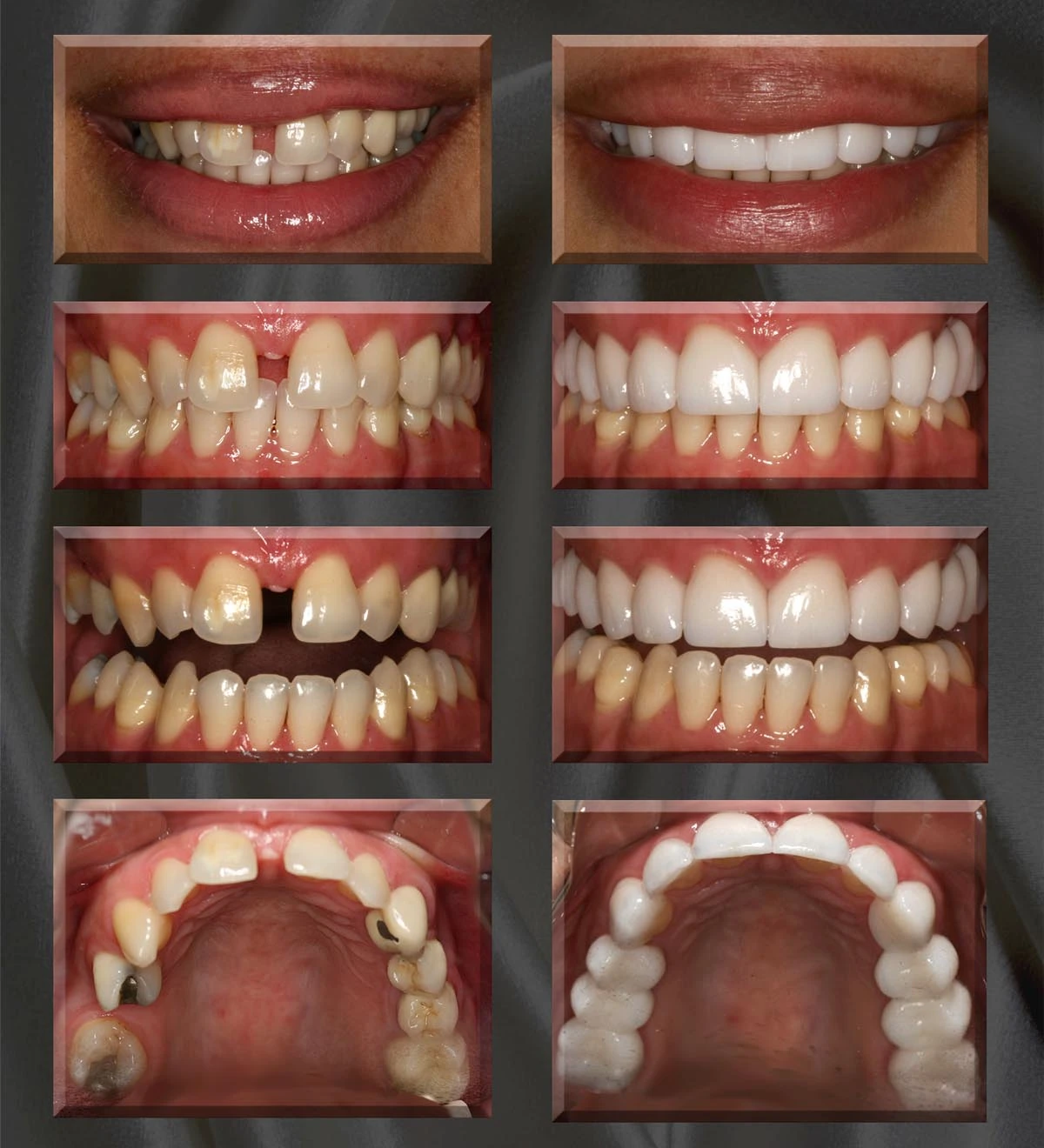 Smile makeover by Dr. Silva shown before and after treatment