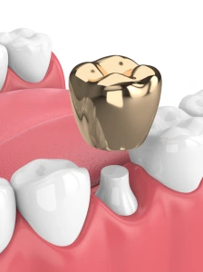 Gold dental crowns may be your best option