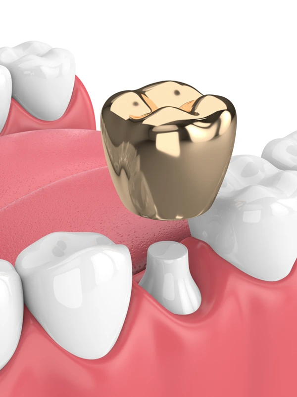 Gold dental crowns may be your best option