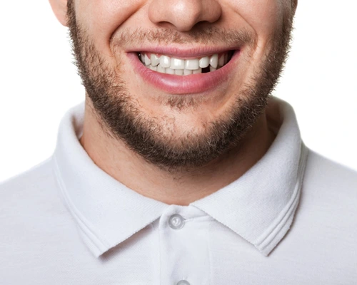 Missing teeth | collegeville advanced dentistry
