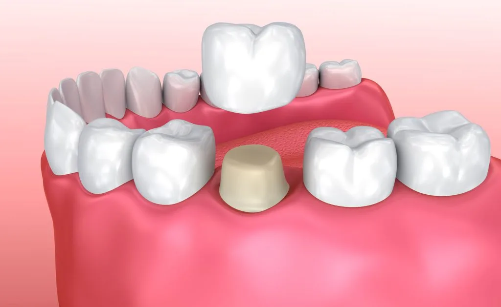 Weighing the Pros and Cons of Dental Crowns | Advanced Dentistry of Collegeville