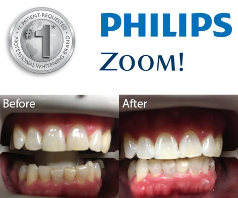 Philips Zoom professional whitening badge and before-and-after comparison showing teeth whitening results from yellow to bright white