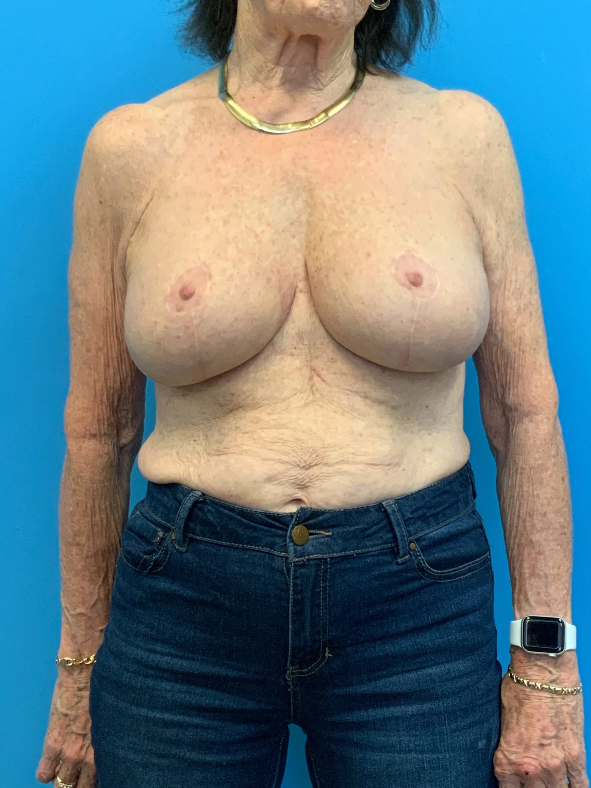 Augmentation-Mastopexy-Case--4504 | After Breast 1