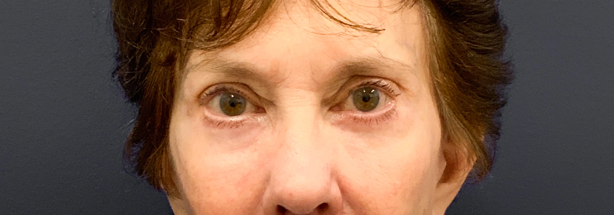 Blepharoplasty-Case--3418 | After Eyelid Surgery 1