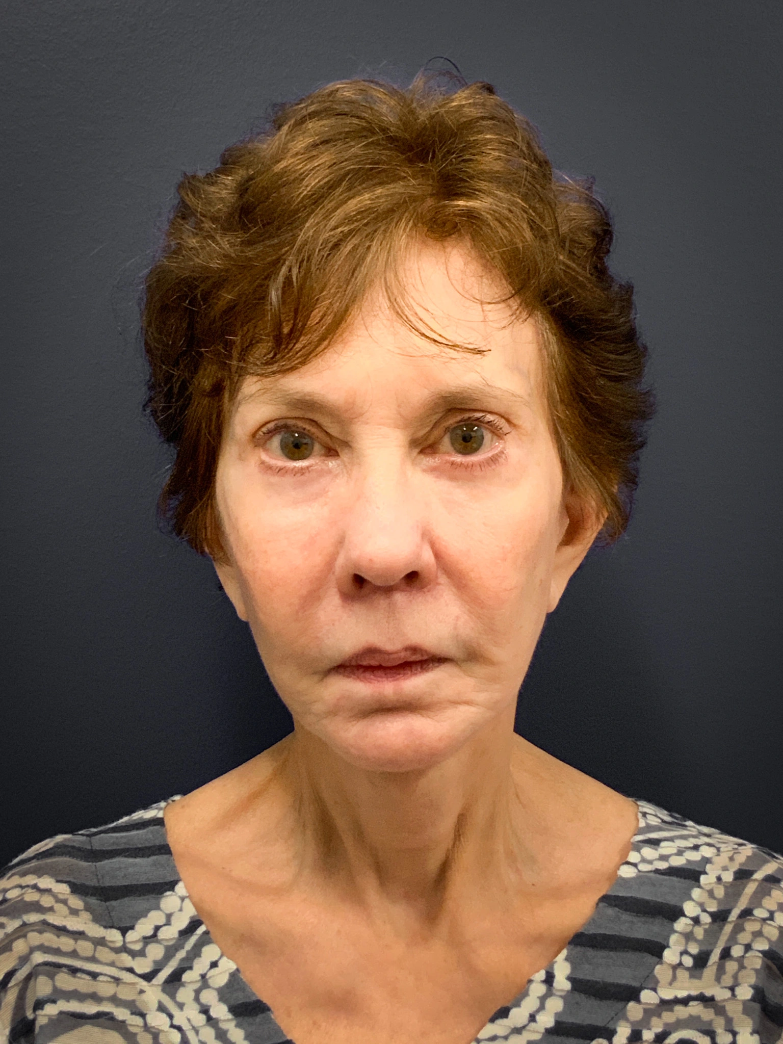Facelift-and-Facial-Fat-Grafting-Case--5079 | After Facial Fat Grafting 1