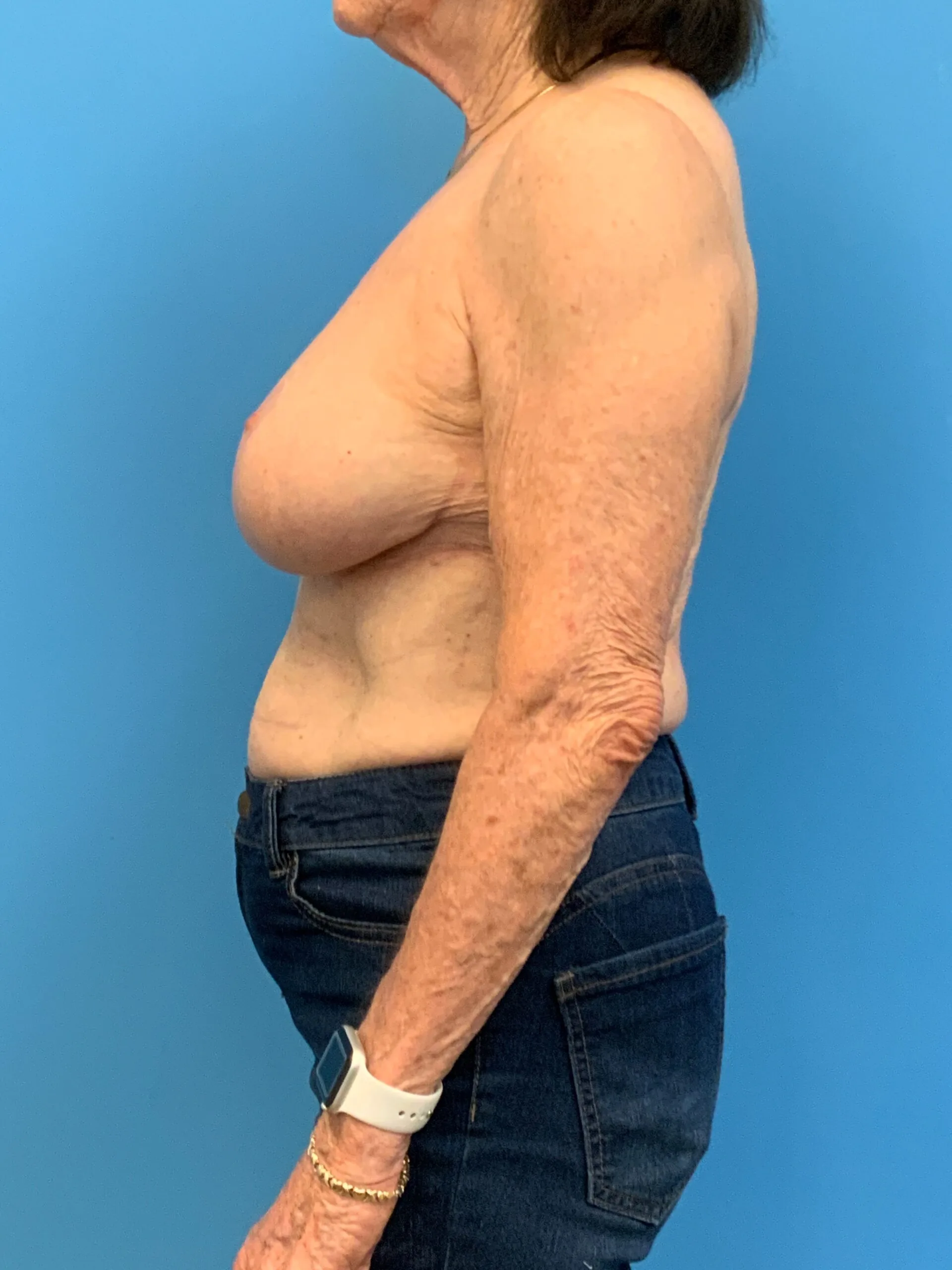 Augmentation-Mastopexy-Case--4504 | After Breast 2