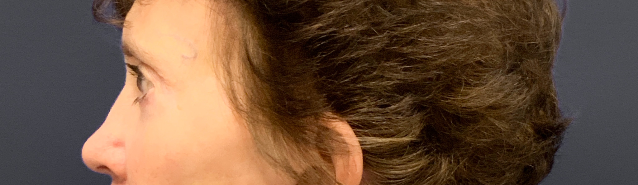 Blepharoplasty-Case--3418 | After Eyelid Surgery 2