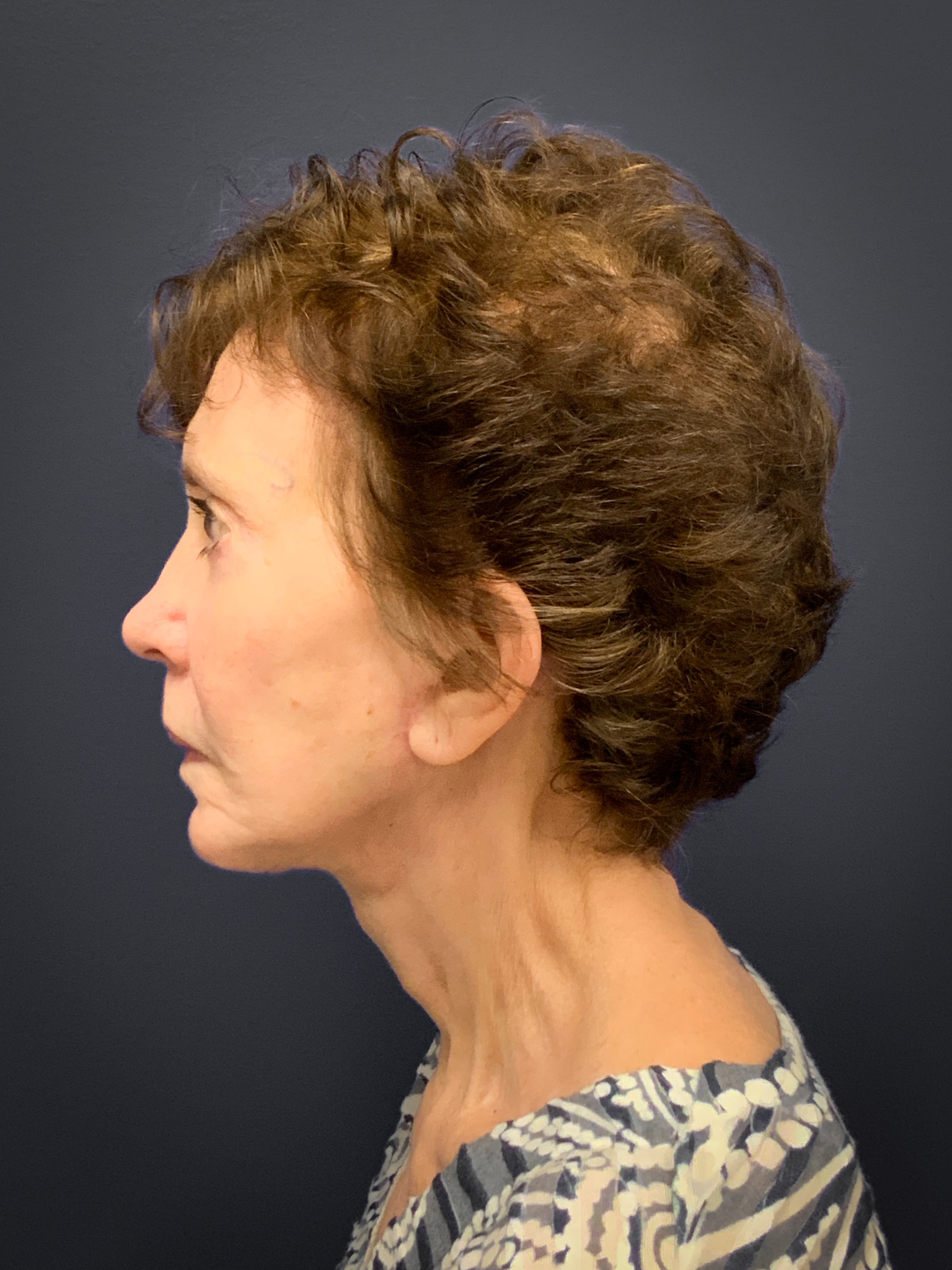 Facelift-and-Facial-Fat-Grafting-Case--5079 | After Facial Fat Grafting 2