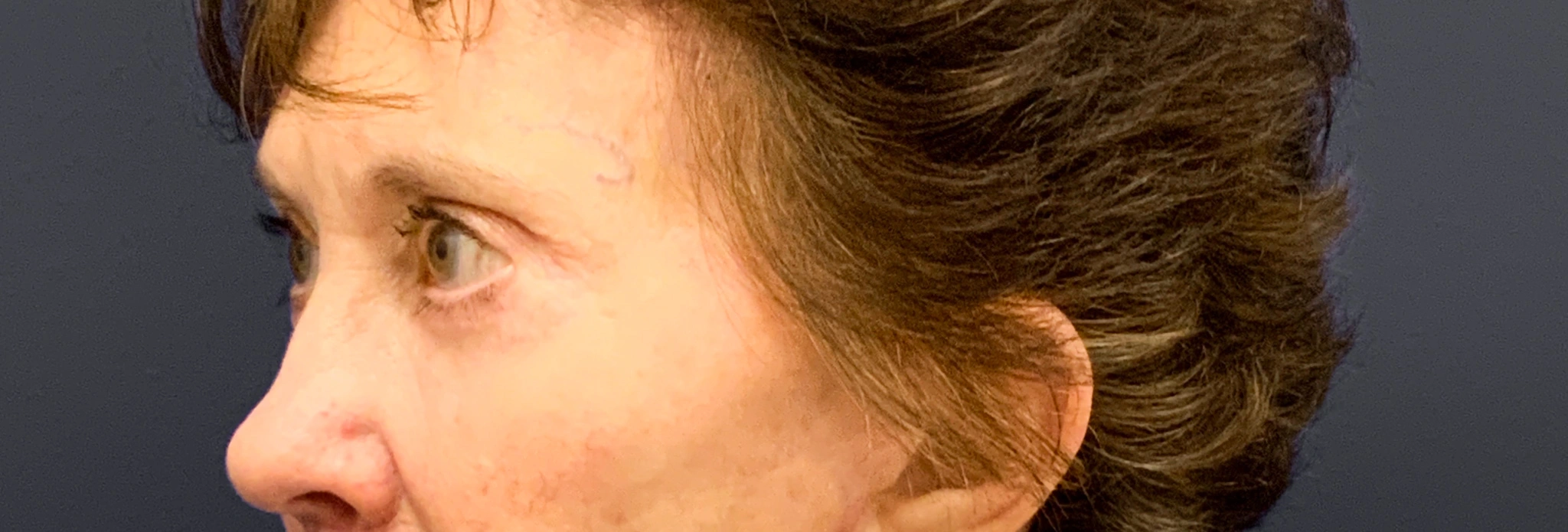 Blepharoplasty-Case--3418 | After Eyelid Surgery 4
