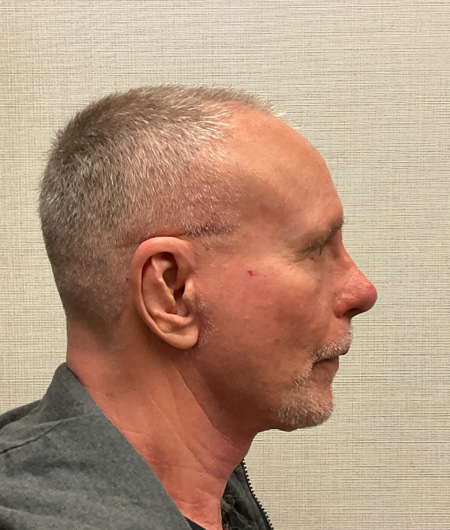 Rhinoplasty-Case--3129 | After Rhinoplasty 3
