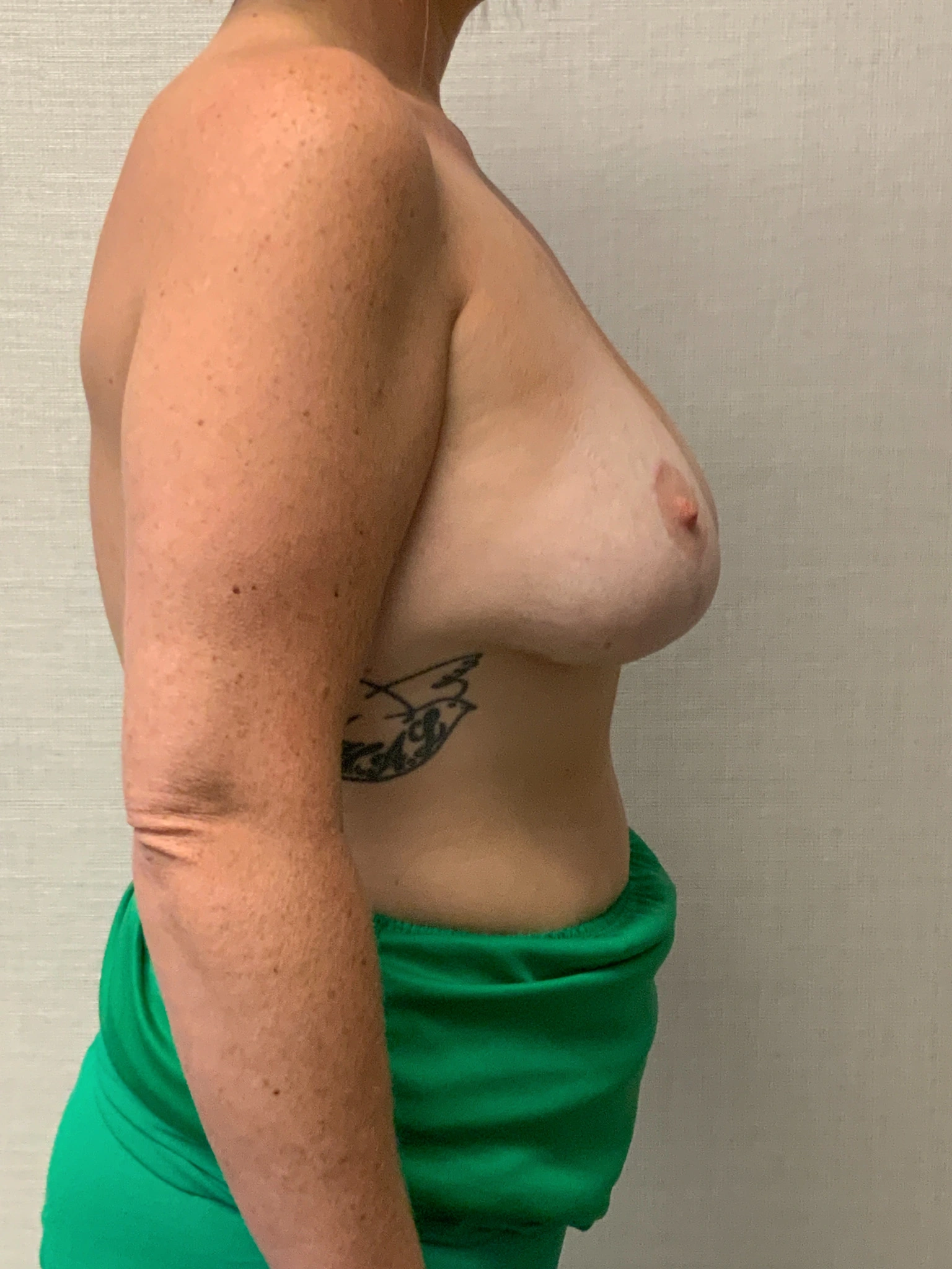 Augmentation-Mastopexy-Case--6355 | After Breast 2