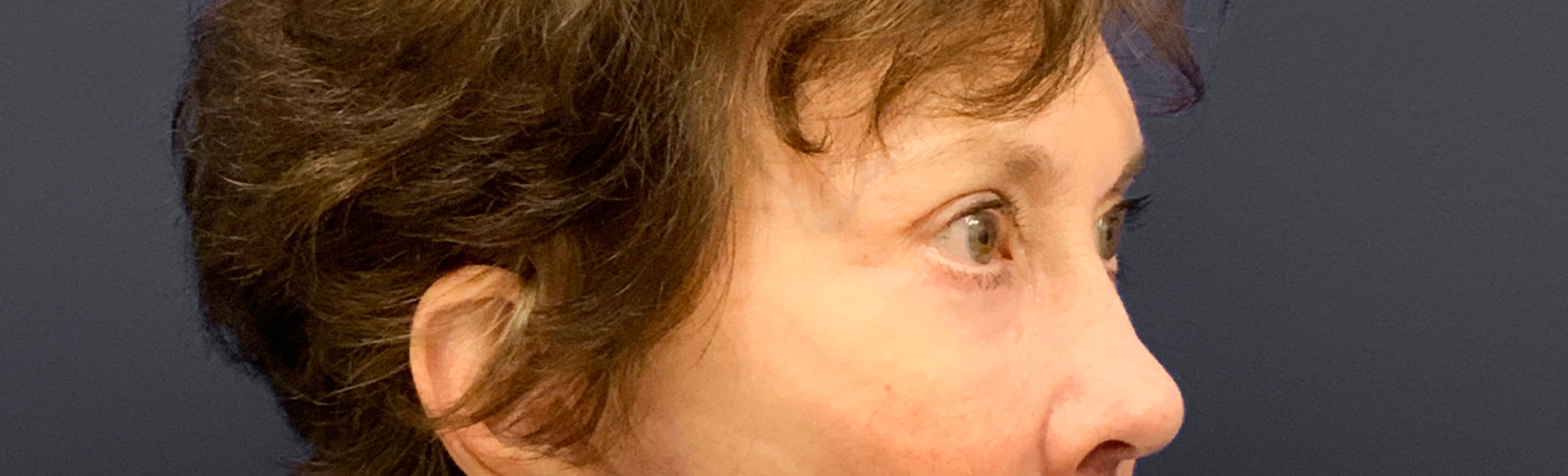 Blepharoplasty-Case--3418 | After Eyelid Surgery 5