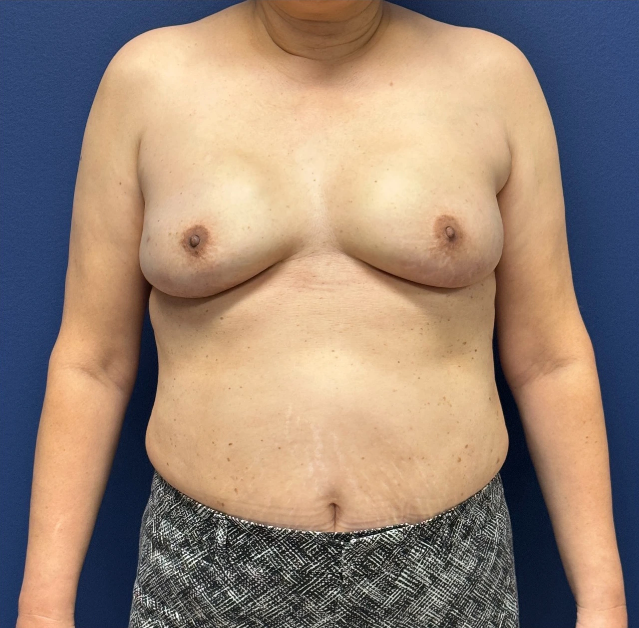 Breast-Reconstruction-Case--28751 | After Breast 1