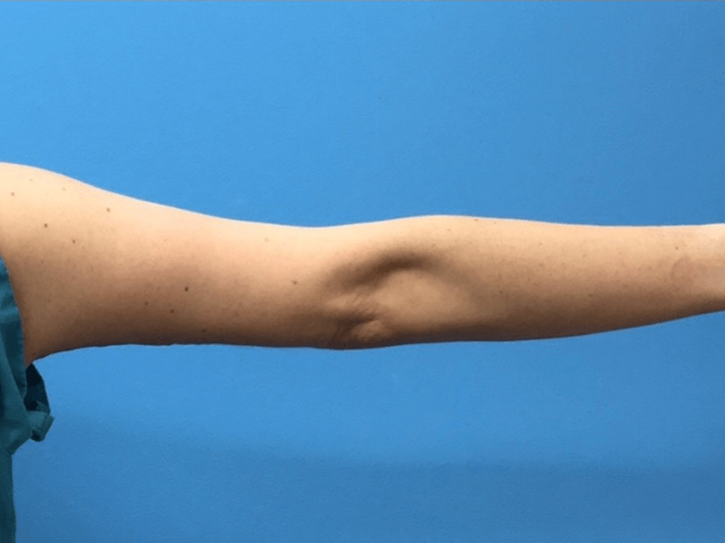 Brachioplasty-Case--276 | After Dr. Samir Rao 2
