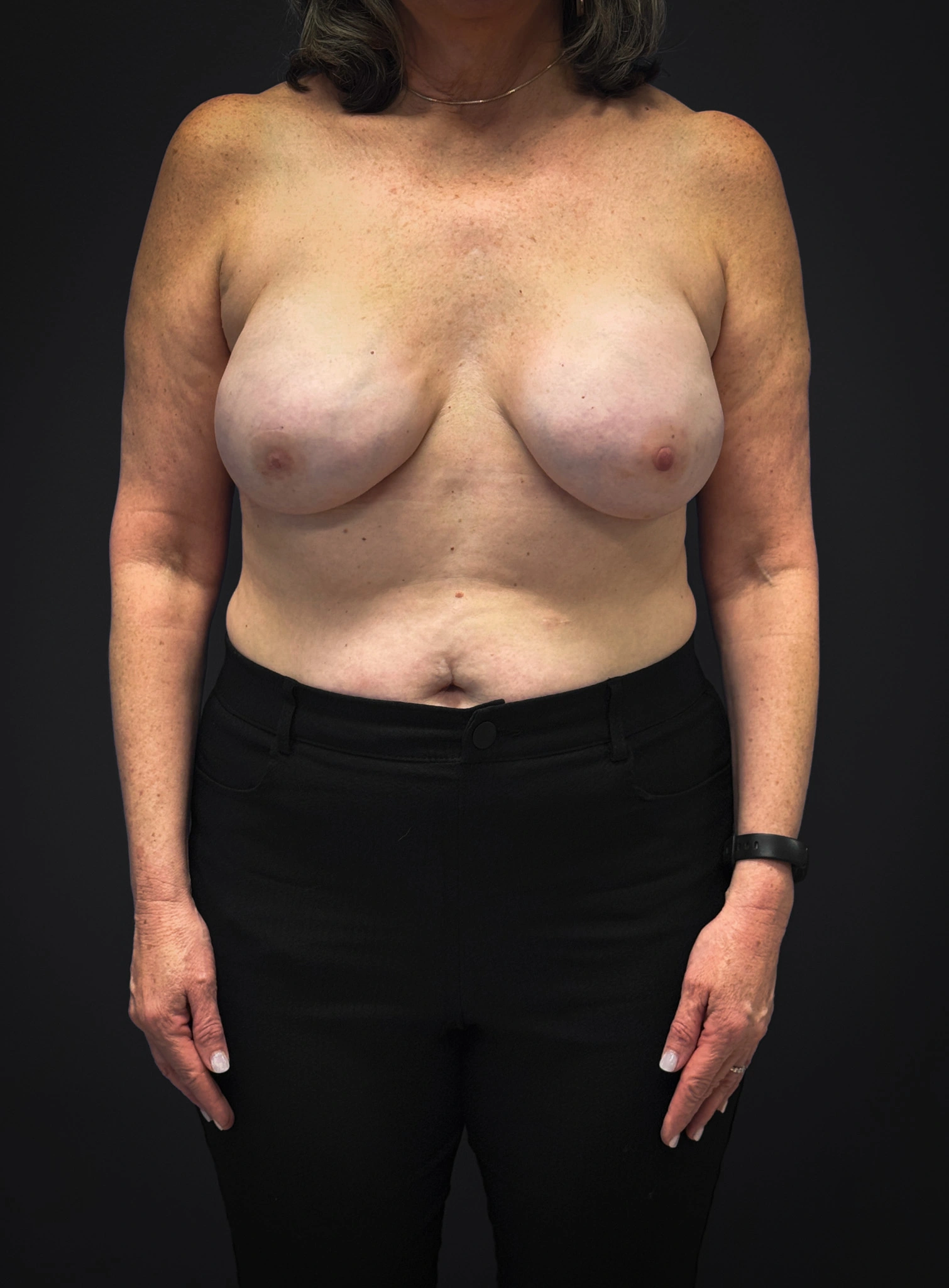 Implant-Reconstruction-Case--2969 | After Breast 1