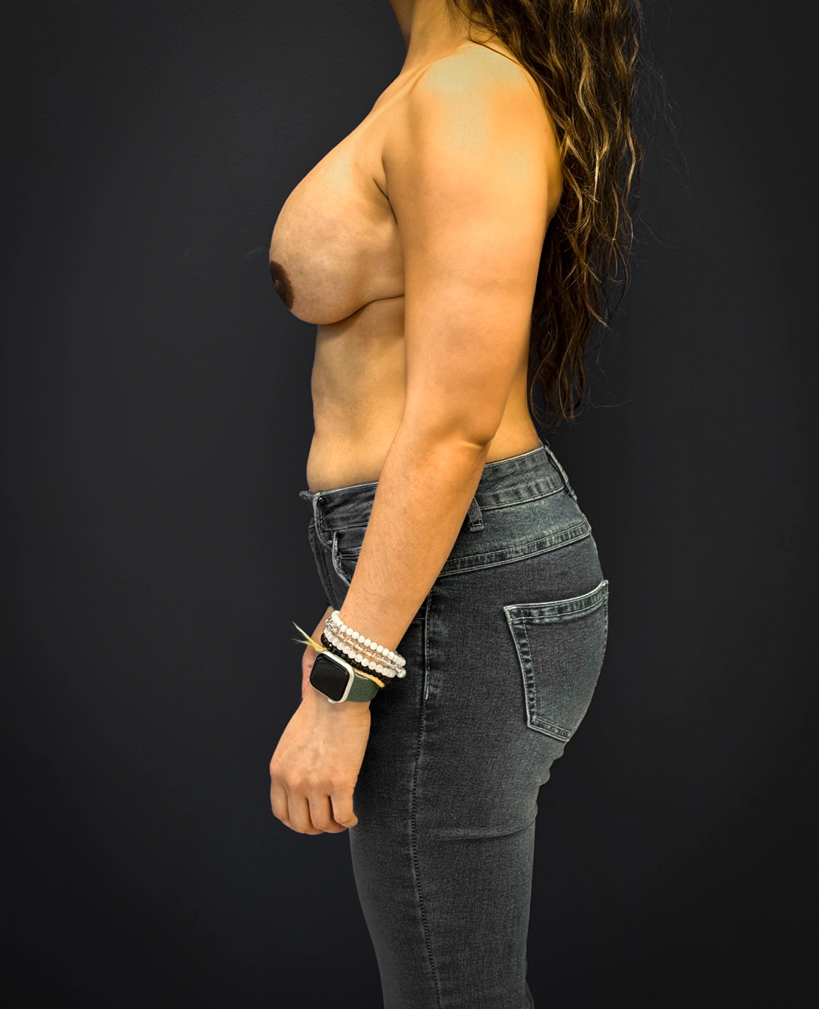 Breast-Reconstruction-Case--7171 | After Breast 2
