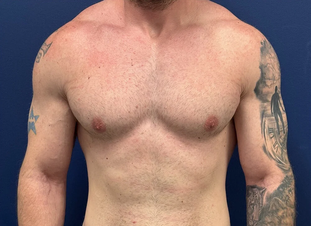 Gynecomastia-Case--28230 | After Breast 1