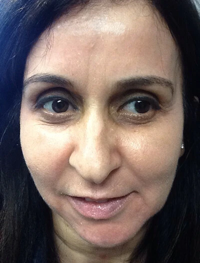 Chemical-Peel-Case--36 | After Non-Surgical 1