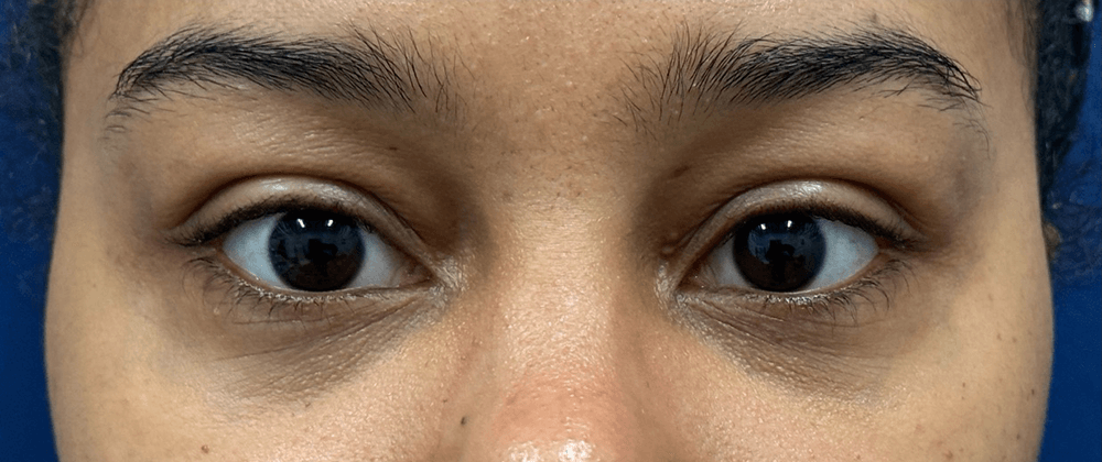 Lower-Blepharoplasty-Case--28049 | After Eyelid Surgery 1